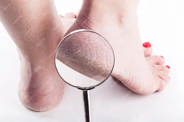 Relief For Dry Feet And Cracked Heels