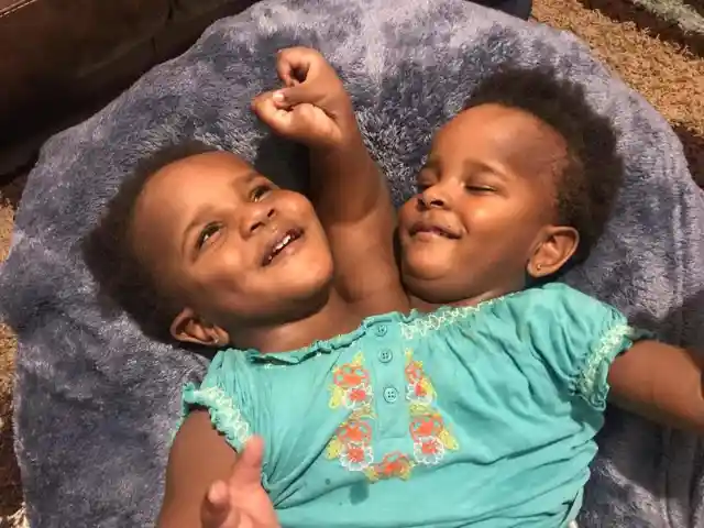 Conjoined Twins