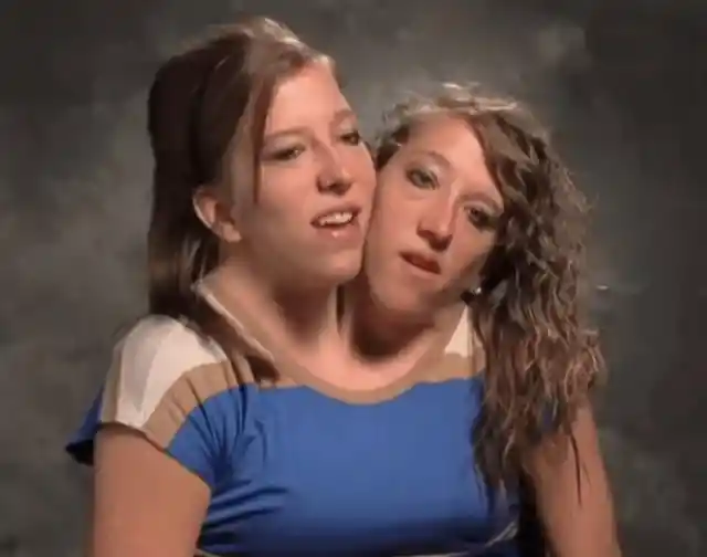 Conjoined Twins Finally Bare All And Reveal What They Truly Look Like After Separation