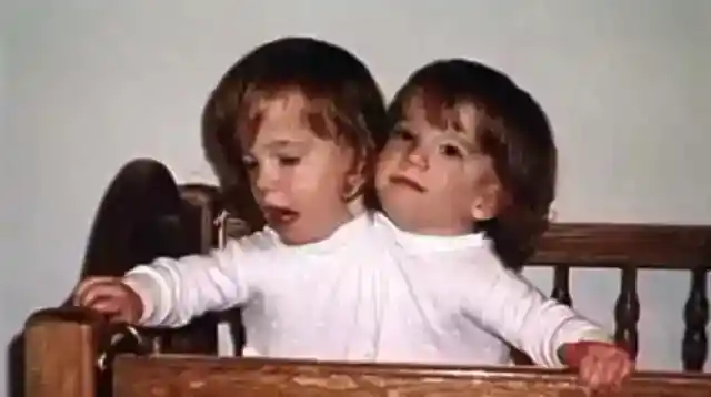 Surgery Removed A Third Arm