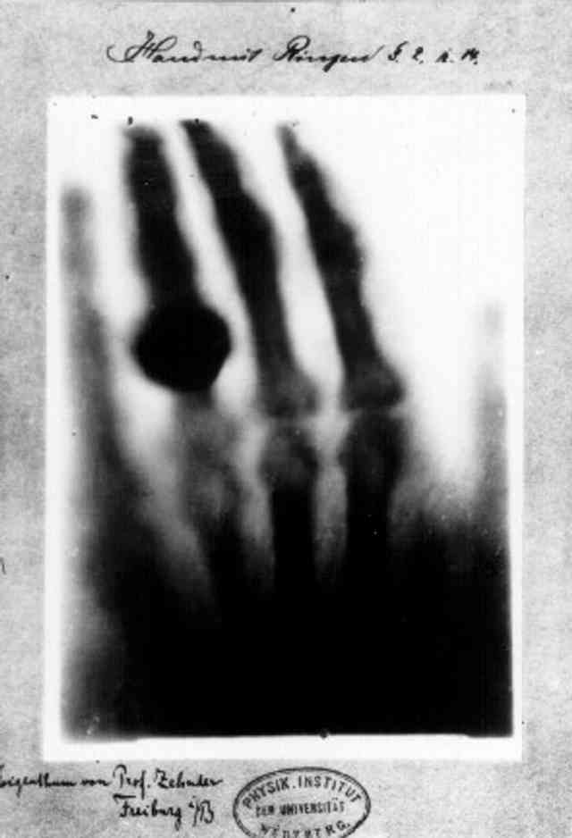 Röntgen's First X-Ray