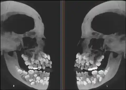 Vampires Or Just Multiple Hyperdontia?