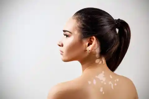 White Skin Patches